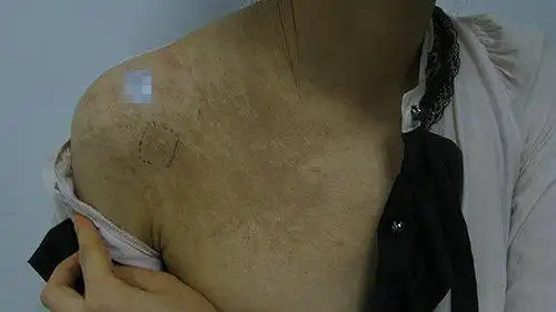 广东燕岭医院:激光治疗毛表皮痣效果如何?