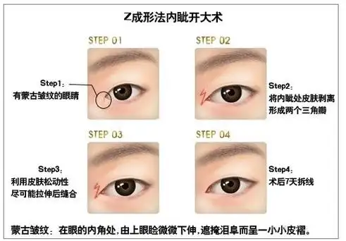 内眦赘皮及上睑多余皮肤的处理,内眦角及下睑的成形等方法来开大内眦