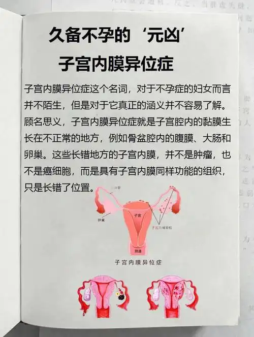 久备不孕都是子宫内膜异位症惹的祸