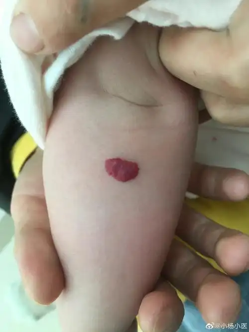 血管瘤_皮肤血管瘤_介绍_症状表现 - 好大夫在线