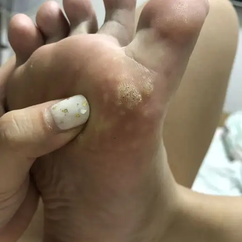 请问脚底长这个是什么!好吓人