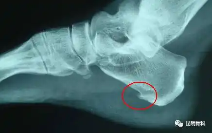 脚后跟长骨刺怎么办?"骨刺"可以磨掉吗?