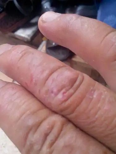 手痒这是什么皮夫病?查好多种药都不起作用?想想办法止痒