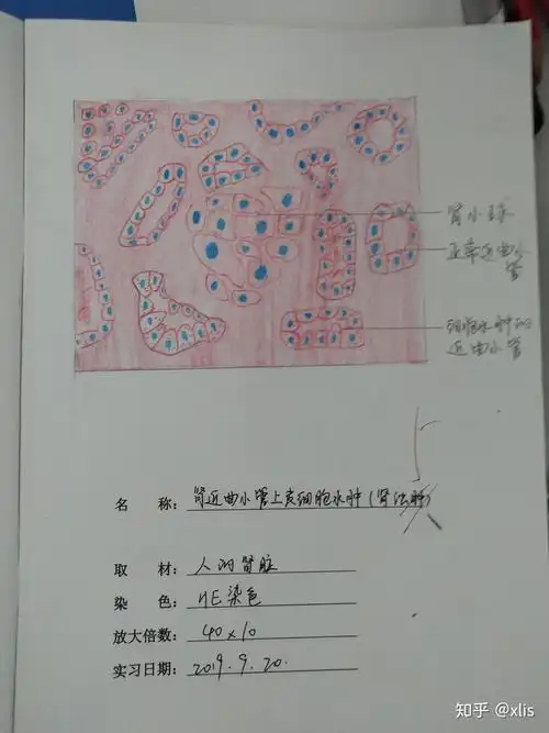 肾近曲小管上皮细胞水肿肾浊肿红蓝铅笔手绘