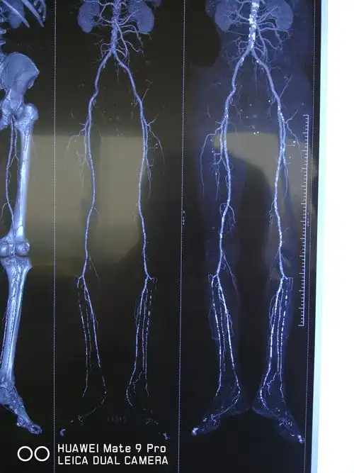 结合临床症状以及相关检查制定个体化治疗方案大腿截肢后表