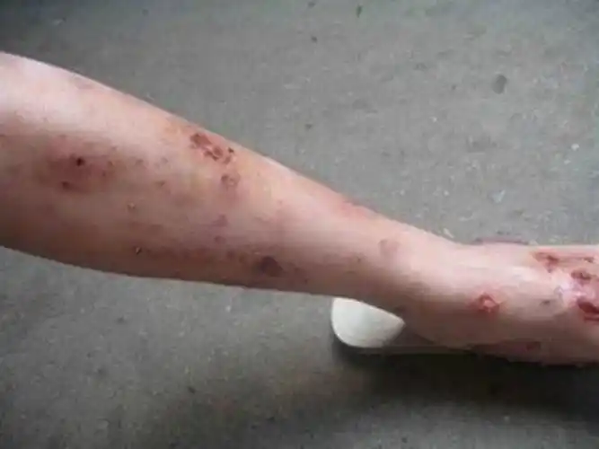 孕妇疥疮初期皮肤症状图片