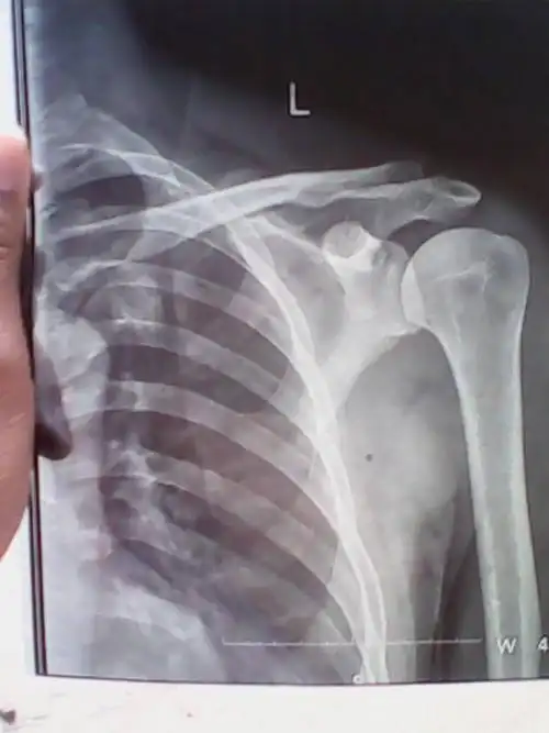 我爸摔伤,可能是肩锁关节脱位,请问医生治疗方法和有什么影响不,谢谢