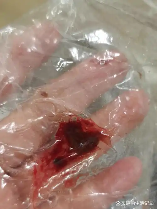 p>孕吐到呕血是一种什么体验 br>不要怕,姐妹们,如果你也遭遇孕吐吐血