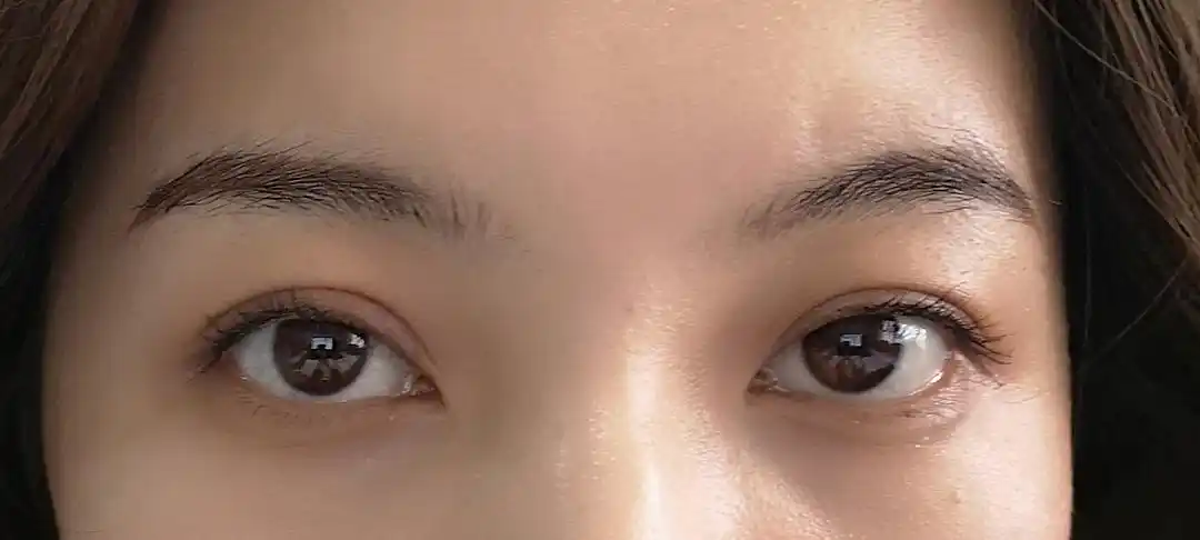 有没有双眼皮肿且宽导致眼睛无神的姐妹