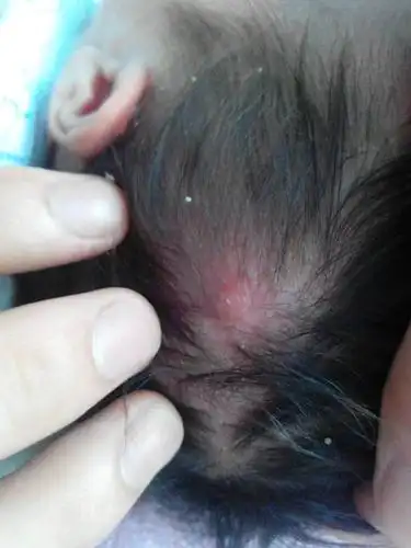 我家宝宝头上这个长得红色疙瘩是什么?_?有点硬!