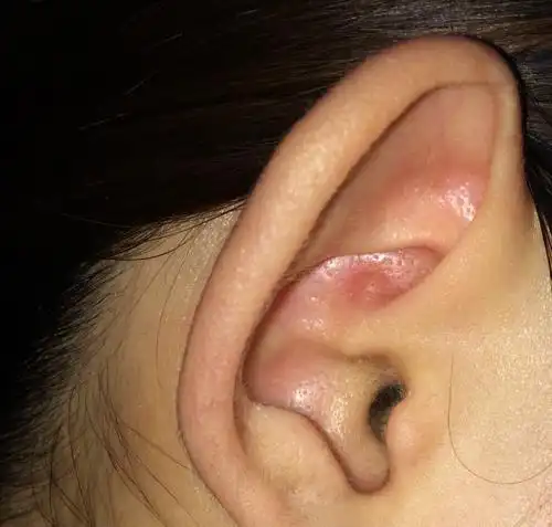 这耳朵长得是什么?很硬,有几个月了,会疼,是带耳机久了才这样吗?