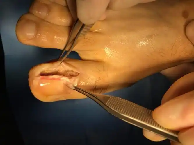 甲沟炎-甲皱壁成型术