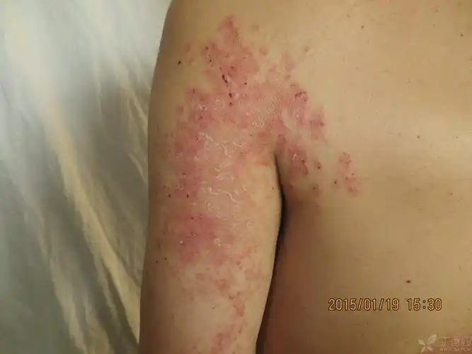 【请教】这个病例,是真菌感染?还是皮炎湿疹?