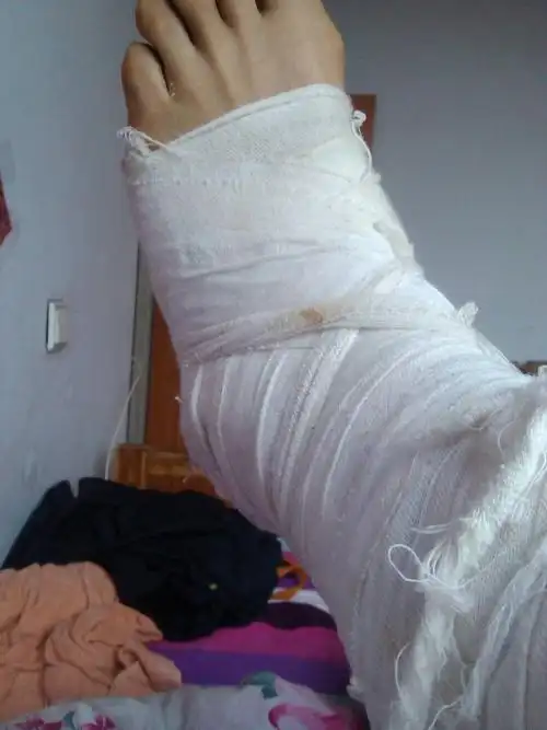 我脚摔骨折了,我是农村的,是给村里农户盖房子摔的,包工头也是我们这