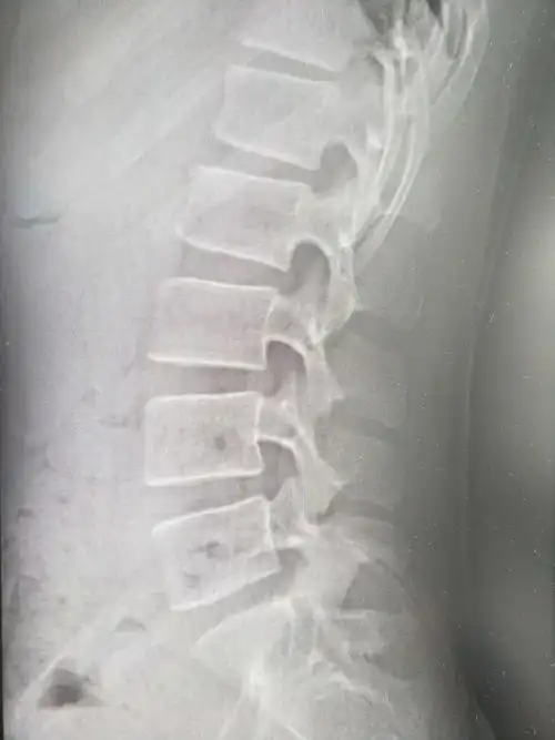 腰椎间盘突出症的阶梯性治疗