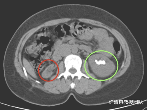 左肾结石-右肾萎缩_肾萎缩_发病原因_治疗方式 - 好大夫在线