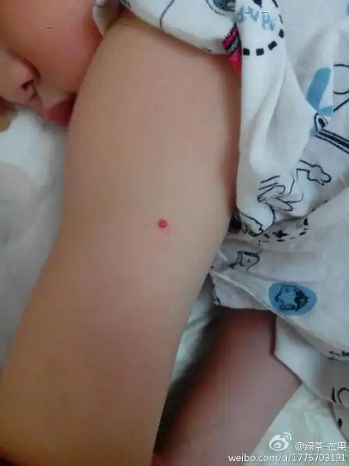 宝宝两周岁半,突然发现宝宝手臂处长了个血痣一样的东西,也不敢抠,想