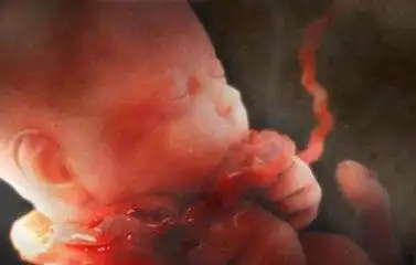 胎儿"脐带绕颈"孕妈们不要慌!