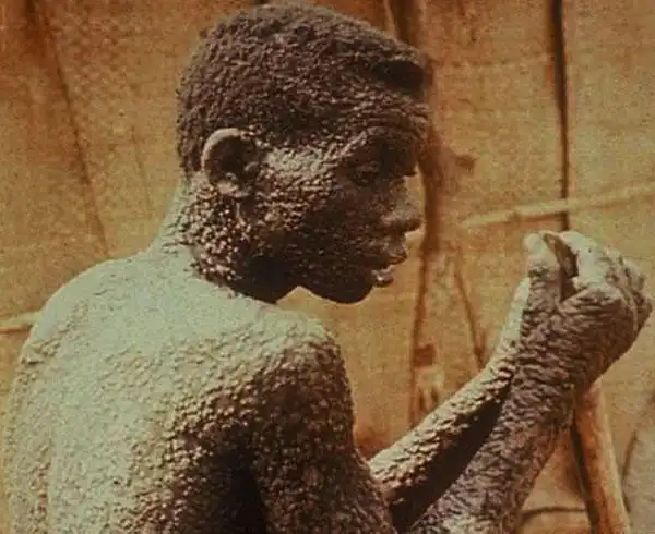 埃博拉病毒患者图片有吗