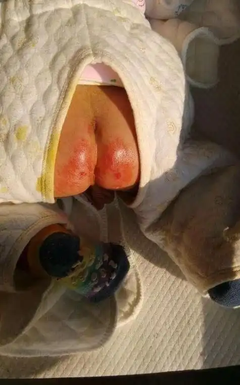 主要是因为女婴儿在小便时,尿液会遗留在小便口(这与女性的生殖系统