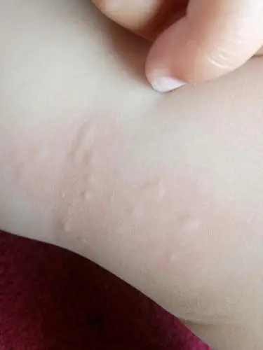 三岁宝宝身上起疙瘩,消失的也快怎么回事