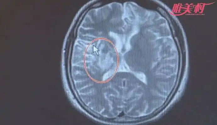 虫子在女子脑袋里生活4年