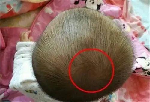 孩子头顶的"旋"你知道代表什么吗?妈妈们一定要看!