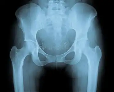 骨盆x光片女性骨盆子宫寄生虫收集远走高飞运行与髋关节损伤概念的