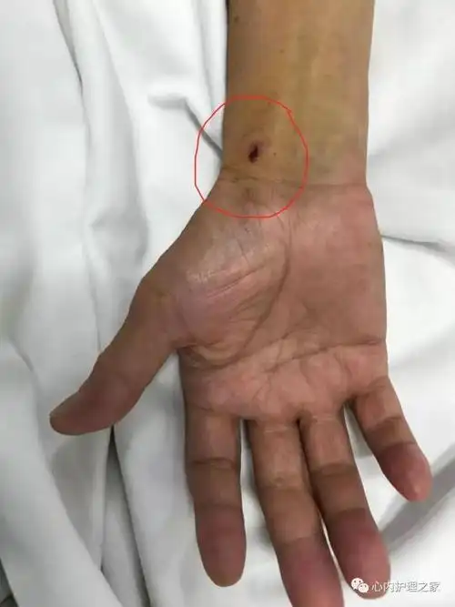 3.回家后,伤口3 天内不能接触水,保持清洁干燥,以免感染.