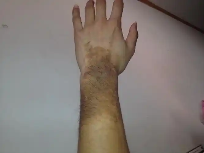 谁能帮我设计个遮丑的彩绘纹身这手臂医生说是胎记除了激光消除没有别