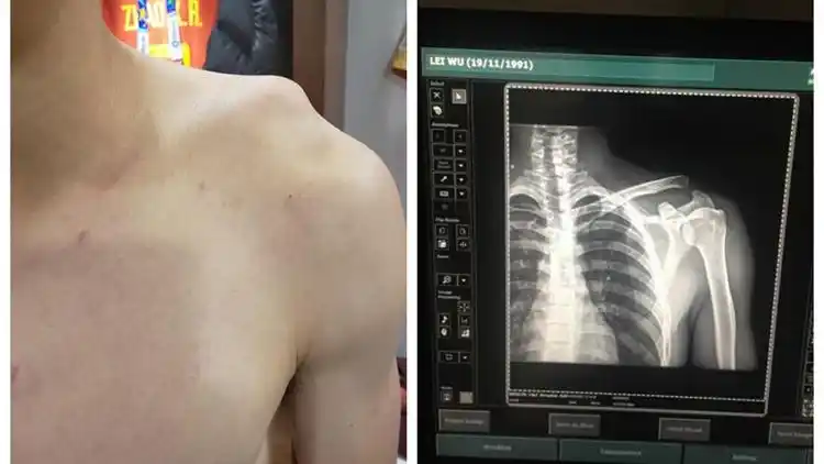 武磊伤情曝光 肩锁关节脱位触目惊心