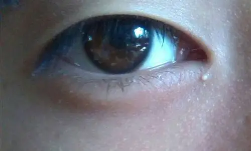 眼角长了个白色疙瘩,是怎么了