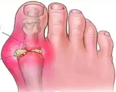 为何一次长途的行走,都能引起痛风的急性发作?