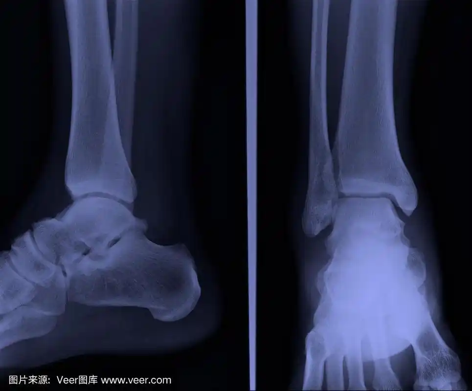 踝关节侧位x线片
