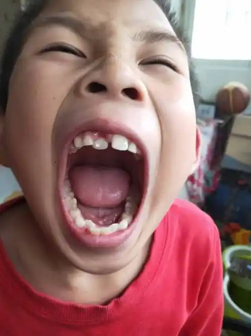 孩子7岁了牙齿重叠牙,门牙有点变形,挺着急.