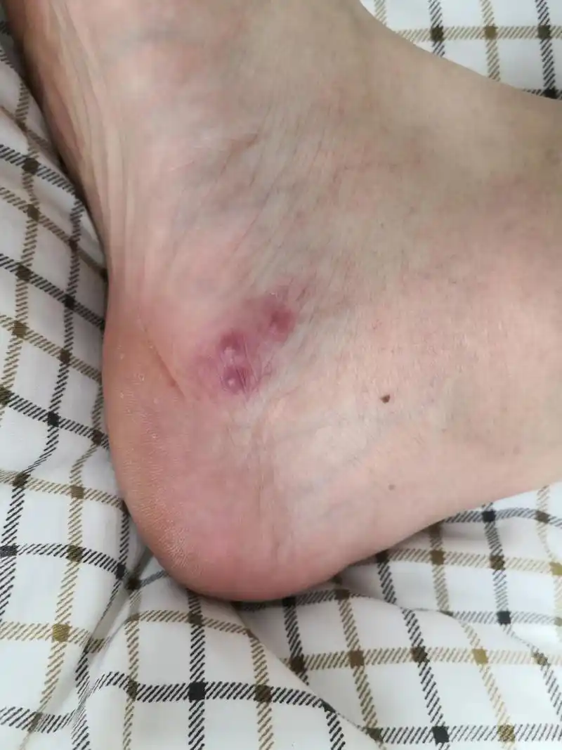 下肢带状疱疹症状#带状疱疹#