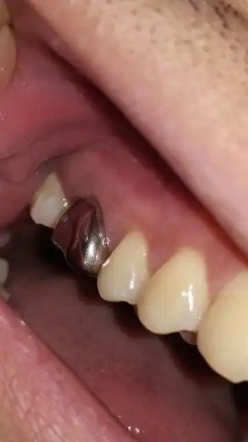 原来金属的牙套毛20年了,想换其它材料的,求推荐