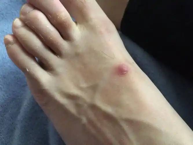 脚面长了一个小红包
