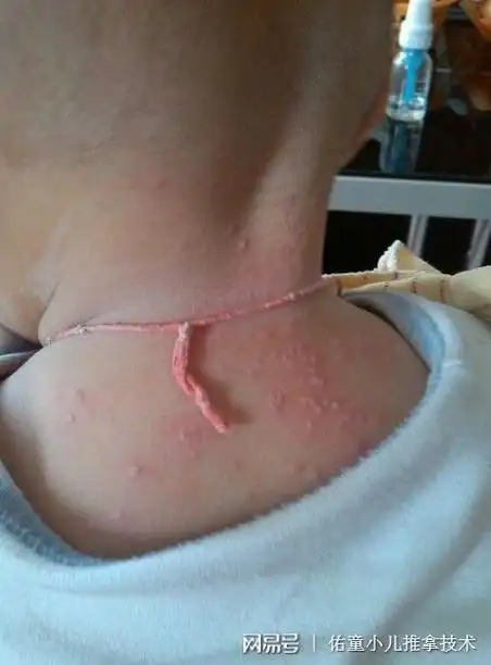 夏天稍不注意易得常见病系列起痱子