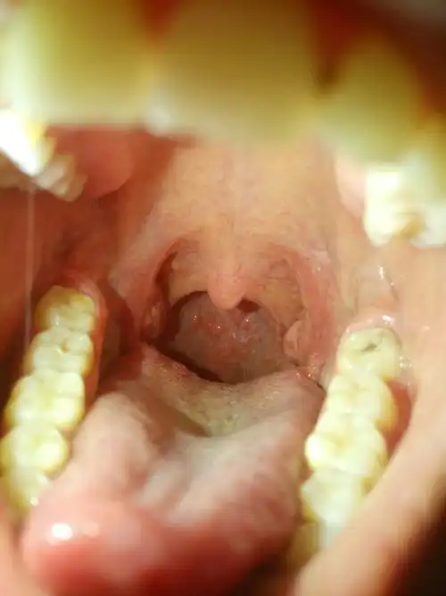 喉咙严重上火还有泡一个多月了还没有好,现在声音也