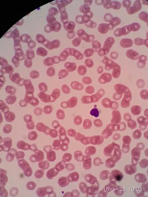 颗粒淋巴细胞形态欣赏