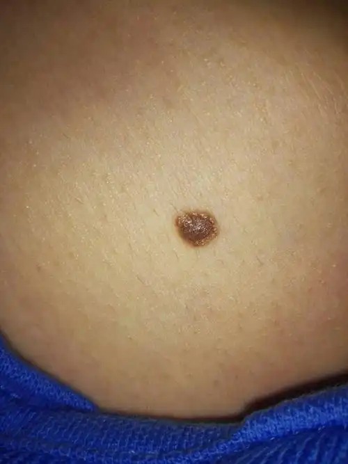 有一颗黑色的突出的痣,严重吗?是不是生病了?