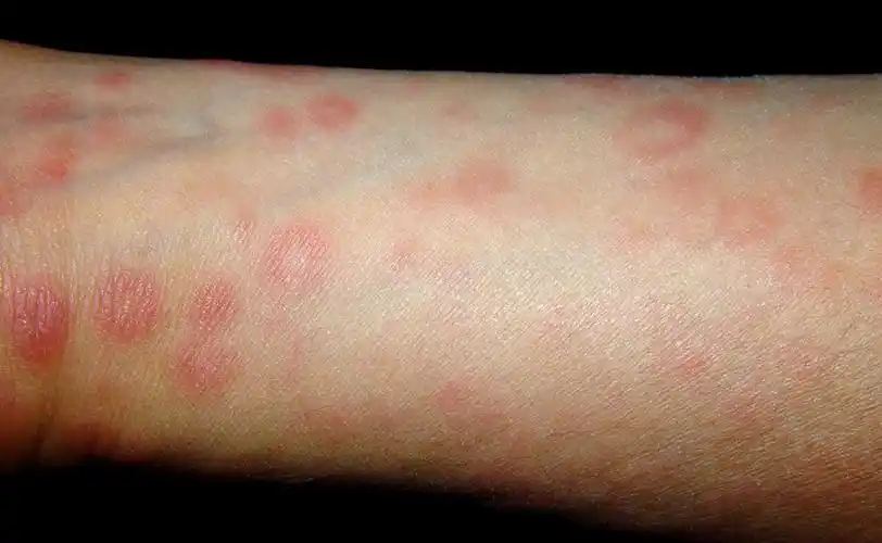 三期梅毒症状临床表现图片三期梅毒马鞍鼻(成人图片上肢内侧斑疹性