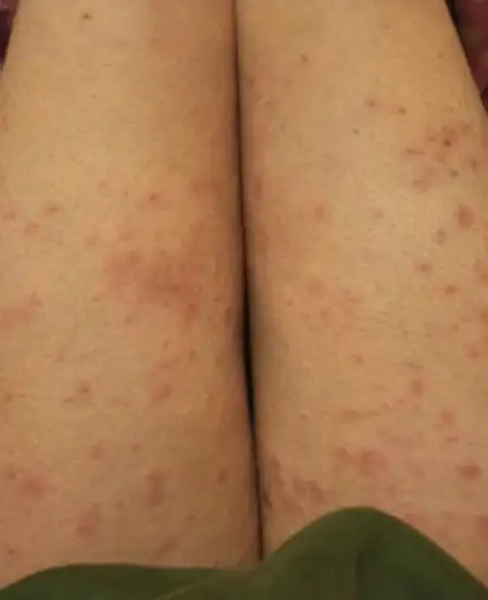 疥疮是什么样的(图片大全)"提供多张疥疮的照片参考图"