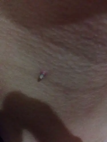 长脖子上的 一年多了 前面白色是后来慢慢长的 白色部分无感觉 去医院