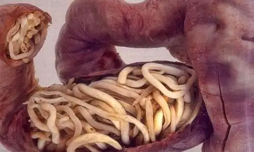 全球十大最恐怖的寄生虫 胆小勿入真的很渗人