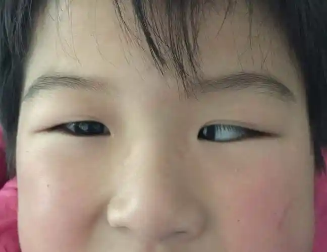 调节性内斜视常发生在2～3岁儿童,患儿通常会伴有中高度远视,或是异常