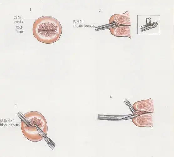 (图) 宫颈组织活检术