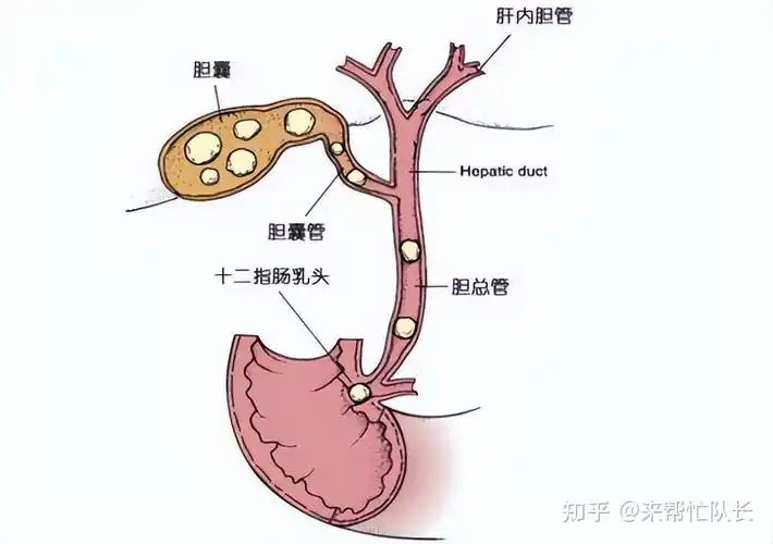 胆管,主要是对胆汁进行输送的管道,胆管位于人体的右上腹,肝内胆管