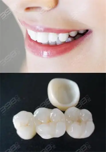 现公布全瓷牙真实成本价格来看看2021全瓷牙多少钱一颗